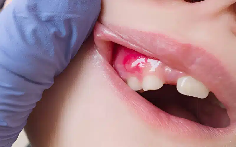 Can a Tooth Abscess Kill You